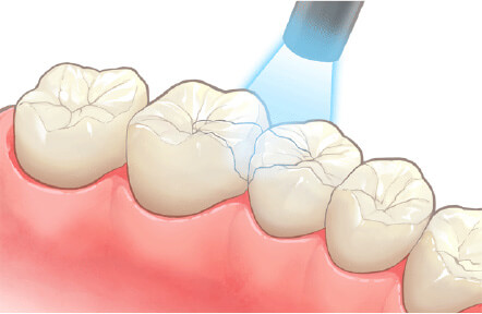 コンポジットレジン充填