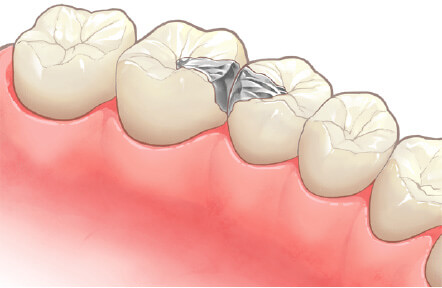 つめ物(インレー)