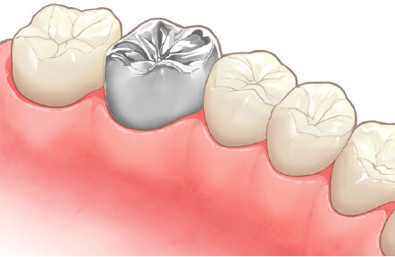 かぶせ物(クラウン)