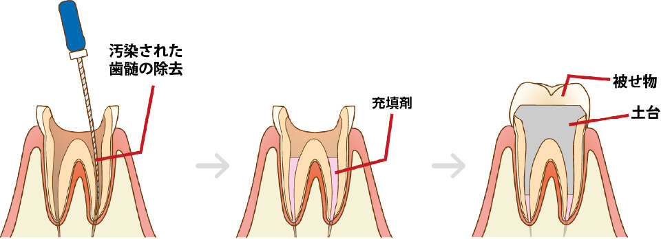 かぶせ物(クラウン)