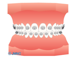 ブラケット矯正(メタル)
