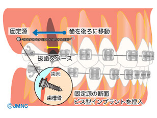 インプラント矯正